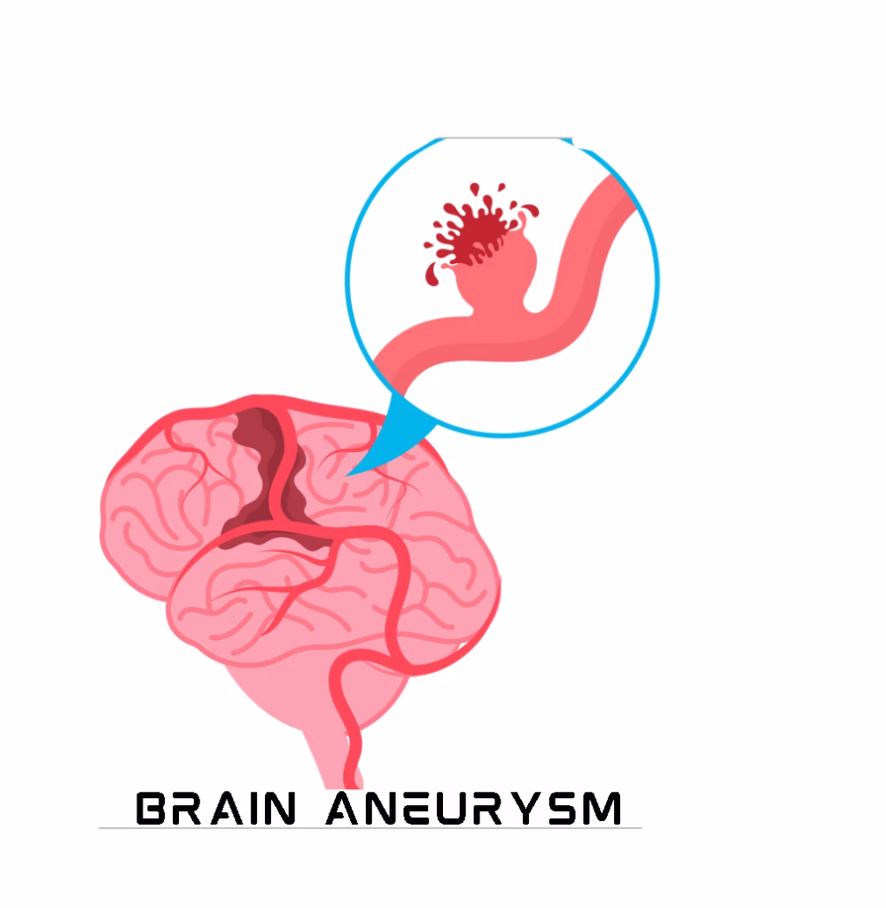 what is a brain aneurysm